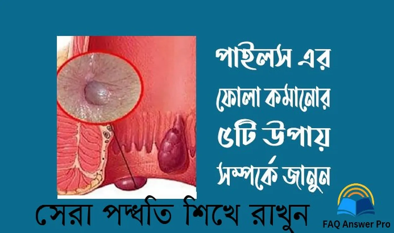 পাইলস এর ফোলা কমানোর ৫টি উপায় বিস্তারিত জানুন